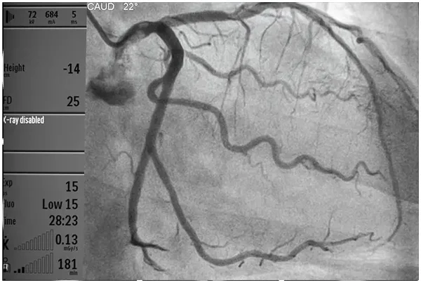 Second Opinion for Angiography