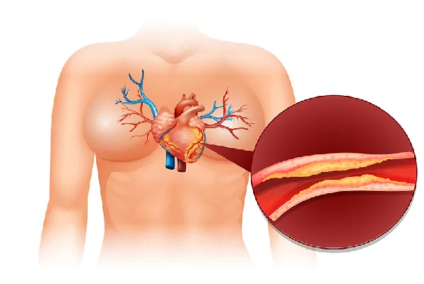 Consultation for High Cholesterol