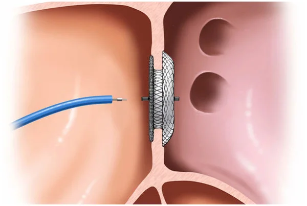 Specialist in Device Closure of Hole in Heart
